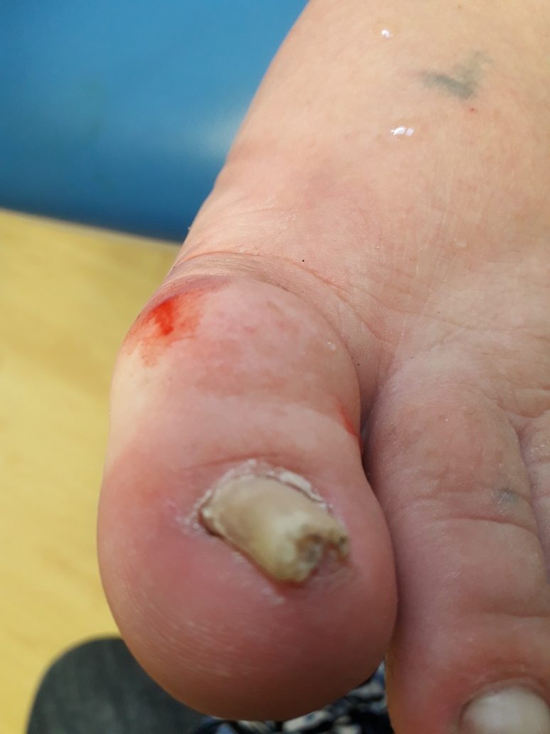 Ingrown Nails  Nova Family Podiatry